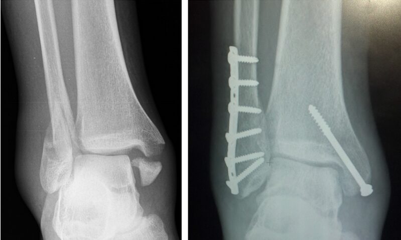Trimalleolar Ankle Fracture Xray