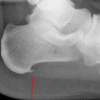 ErgoPad® redux heel 2