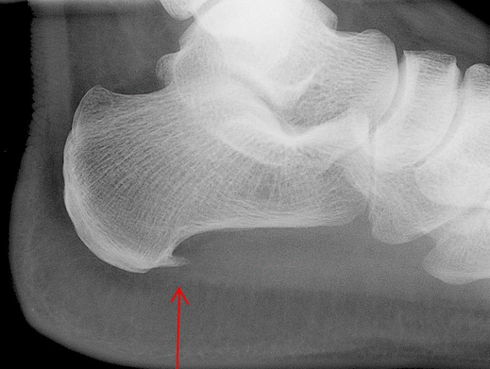 ErgoPad® redux heel 2