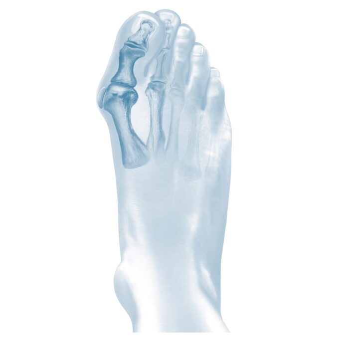 ErgoPad® redux hallux